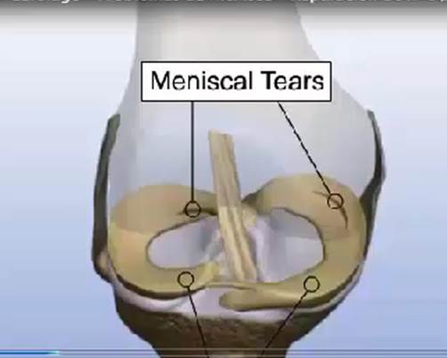 Reparación Menisco